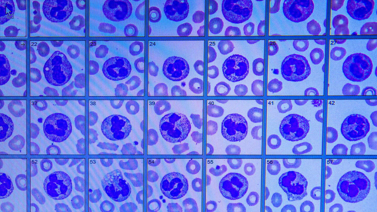 Digital image of whole blood slides used to identify and count red cells, white cells and platelets