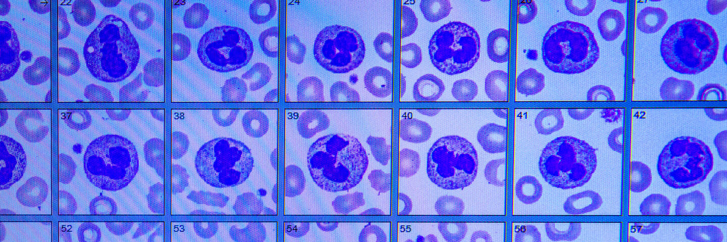 Digital image of whole blood slides used to identify and count red cells, white cells and platelets